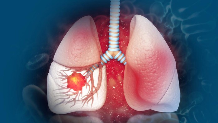 Waspada! Perubahan pada Kuku Bisa Jadi Tanda Kanker Paru