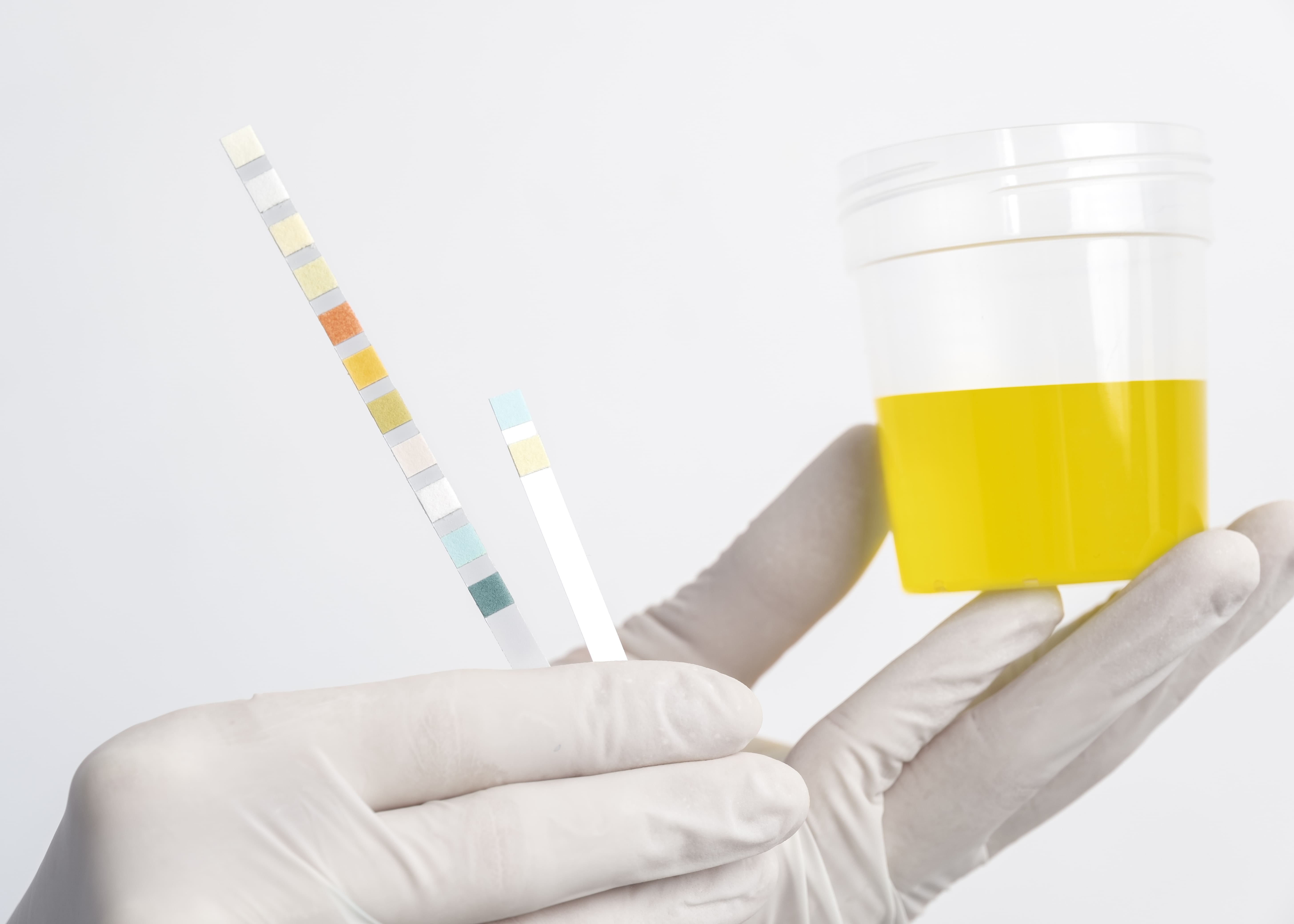 5 Alasan Mengejutkan Mengapa Urine Anda Berwarna Kuning: Cek Sekarang!