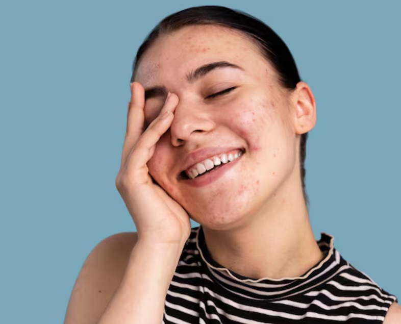 Wajah Tiba-Tiba Berjerawat dan Rambut Rontok Parah? Bisa Jadi Karena Hal Ini