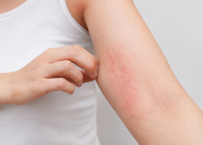 Diabetes Tak Hanya di Gula Darah, Ini Tanda yang Muncul di Kulit