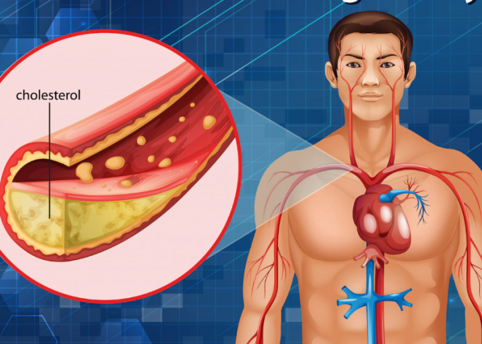 Ternyata Puasa Bisa Turunkan Kolesterol Loh…Ini 6 Cara Alami Turunkan Kolesterol Tinggi 