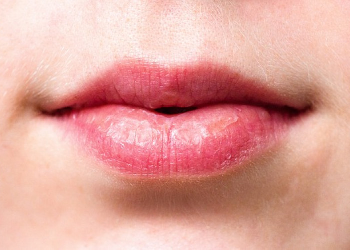 8 Tips Mengatasi Bibir Kering dan Pecah-pecah, Bibir Auto Lembab dan Sehat