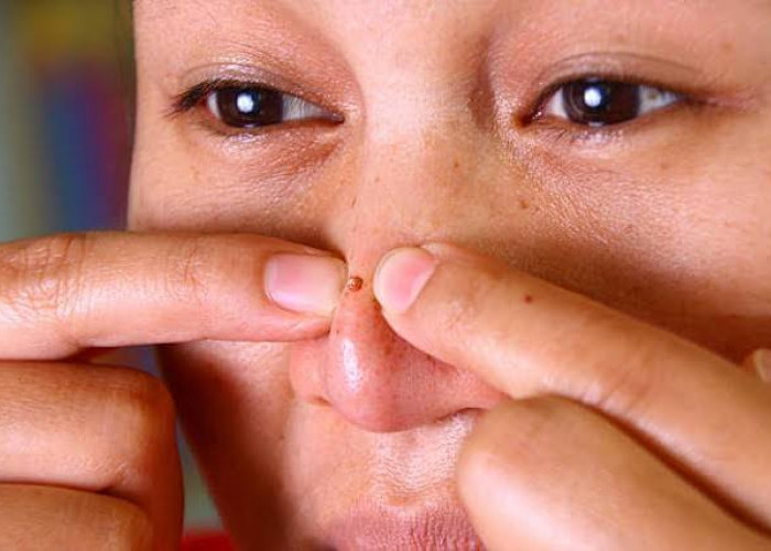 Bikin Kesal dan Gak Pede, Ini Tips Menghilangkan Jerawat di Hidung