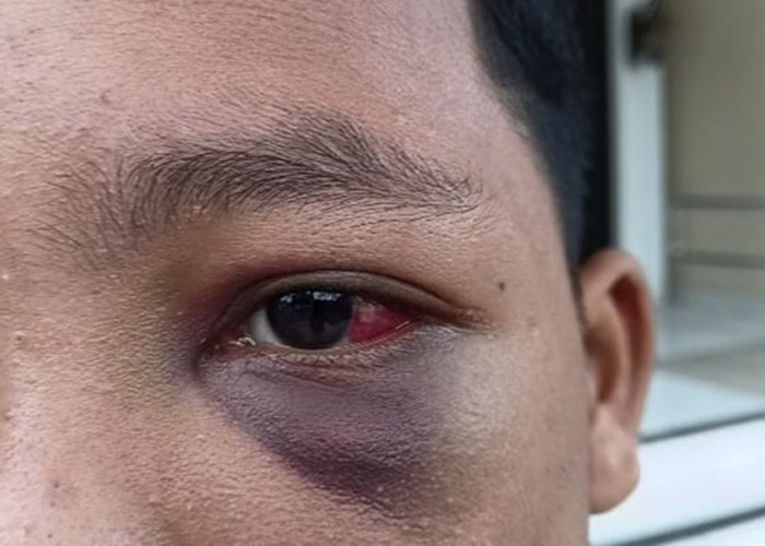Siswa Pesantren di Muaro Jambi Mengaku Dianiaya Guru, Kakak Syok Lihat Kondisi Matanya