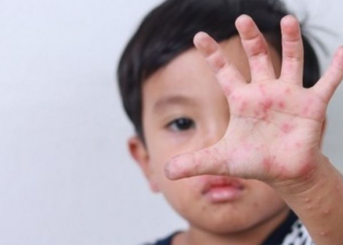 11 Tips Mencegah Anak Terserang Penyakit Flu Singapura