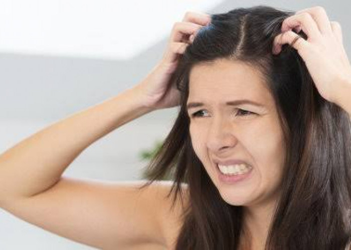 Enyahkan Gatal di Kepala, Ini 9 Tips Menghilangkan Ketombe Membandel di Rambut