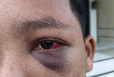 Siswa Pesantren di Muaro Jambi Mengaku Dianiaya Guru, Kakak Syok Lihat Kondisi Matanya